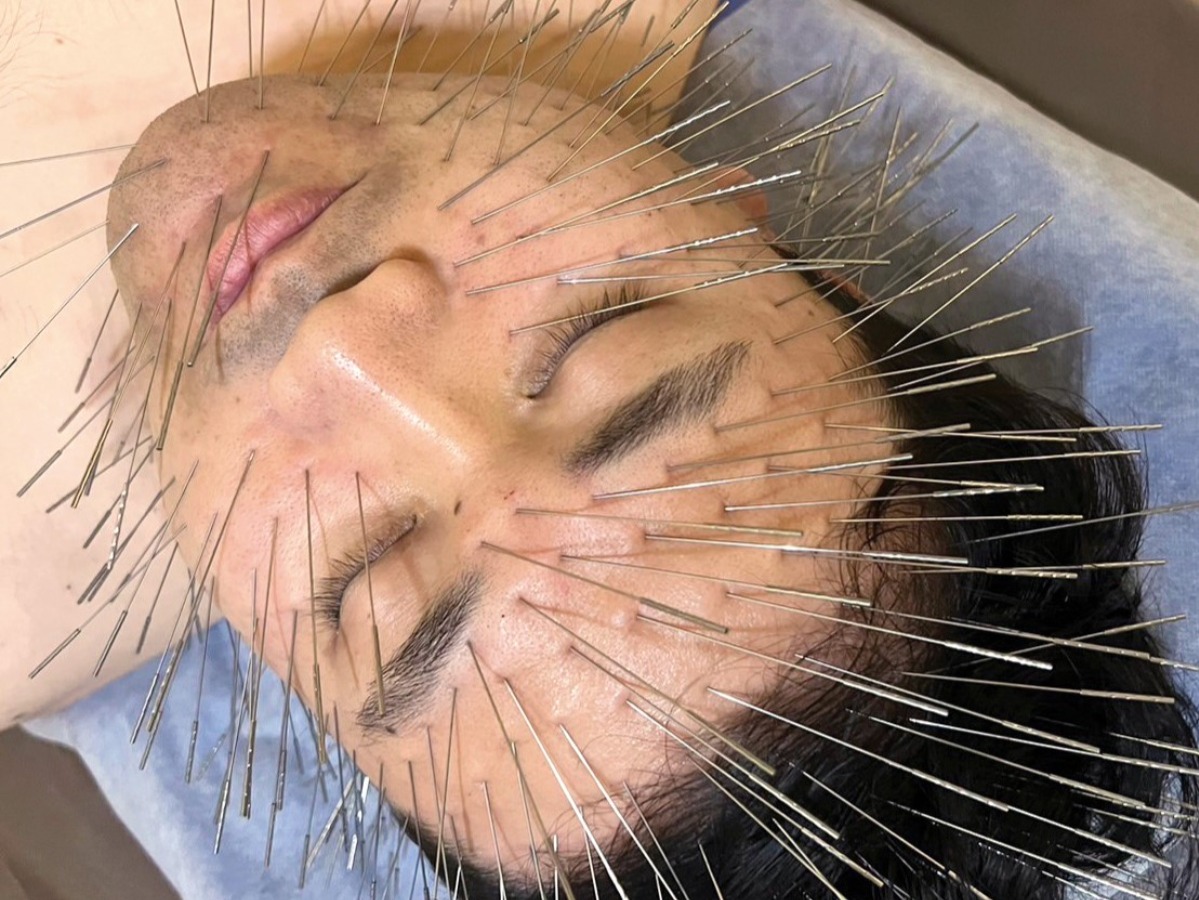 【bibibi 2024 Summer】ルート鍼治療専門院 はり・きゅう KURODA応神「凝り改善ですっきり小顔へ」