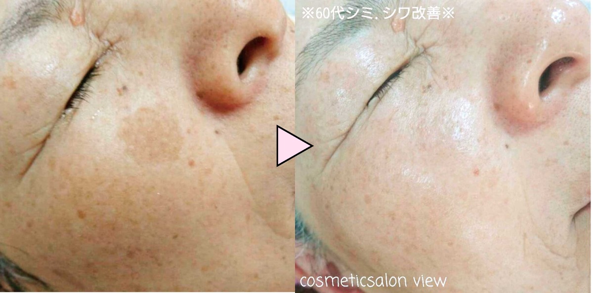 Cosmetic salon view(ビュー)【bibibi 2025 Summer】夏のダメージが、秋には老化の原因に 来年40周年の安心サロンで肌ケアを